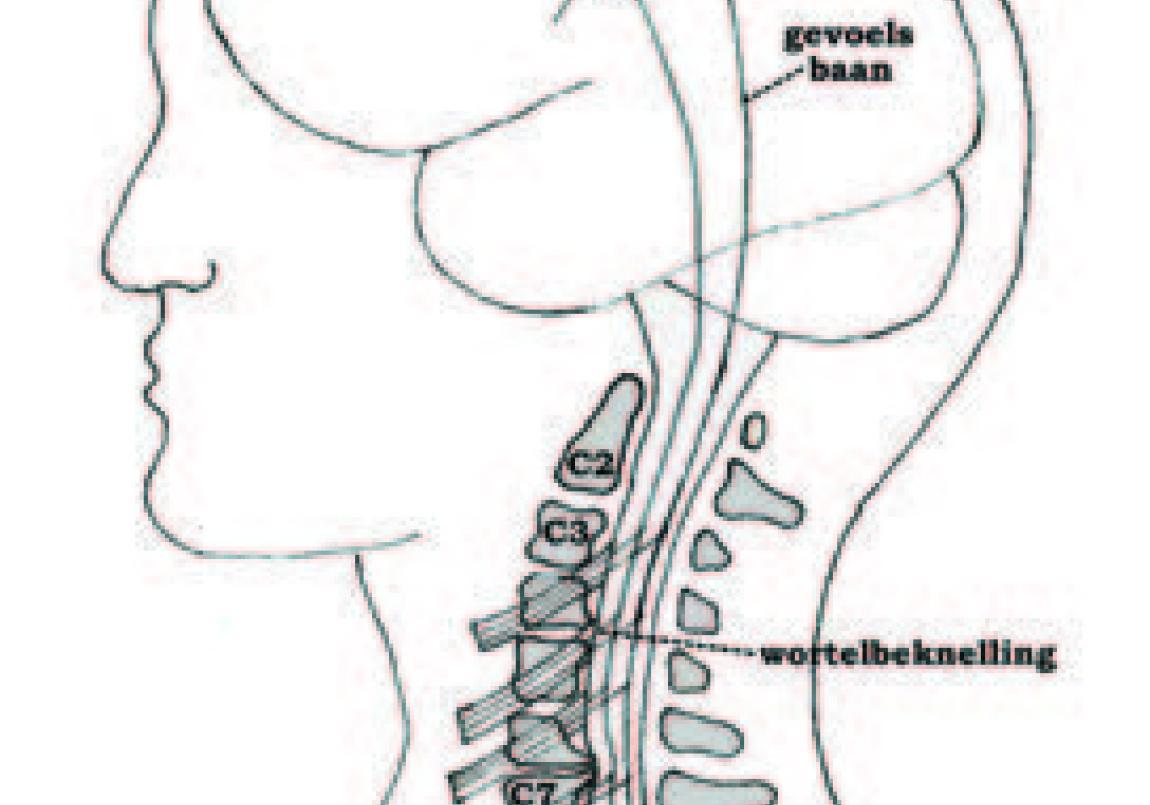 Wervel-, Wortelkanaalvernauwing En Nekhernia (operatie) | St. Antonius ...