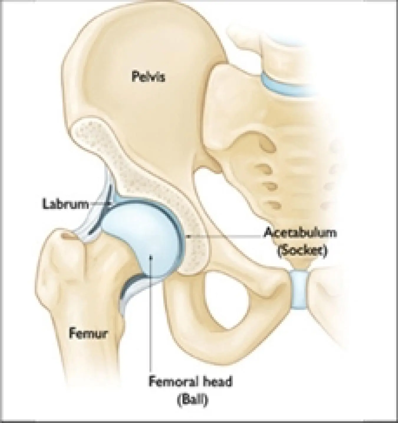 Impingement van de heup